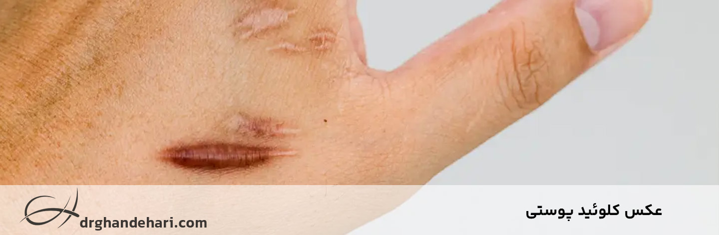 عکس بیماری کلوئید عکس بیماری کلوئید