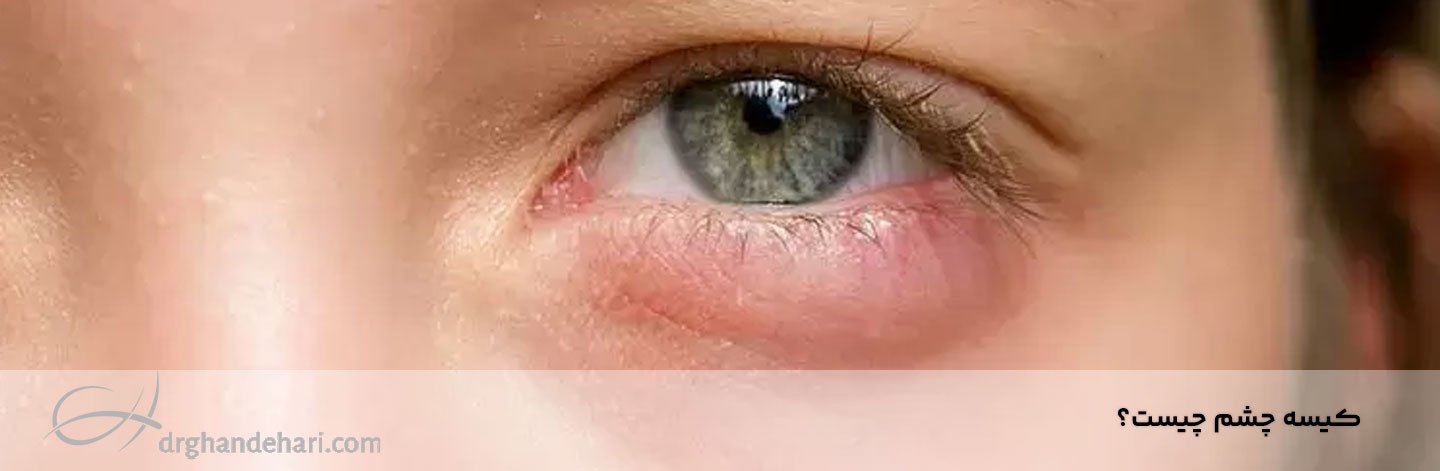 کیسه چشم چیست؟ چگونه کیسه های زیر چشم را برطرف کنیم؟