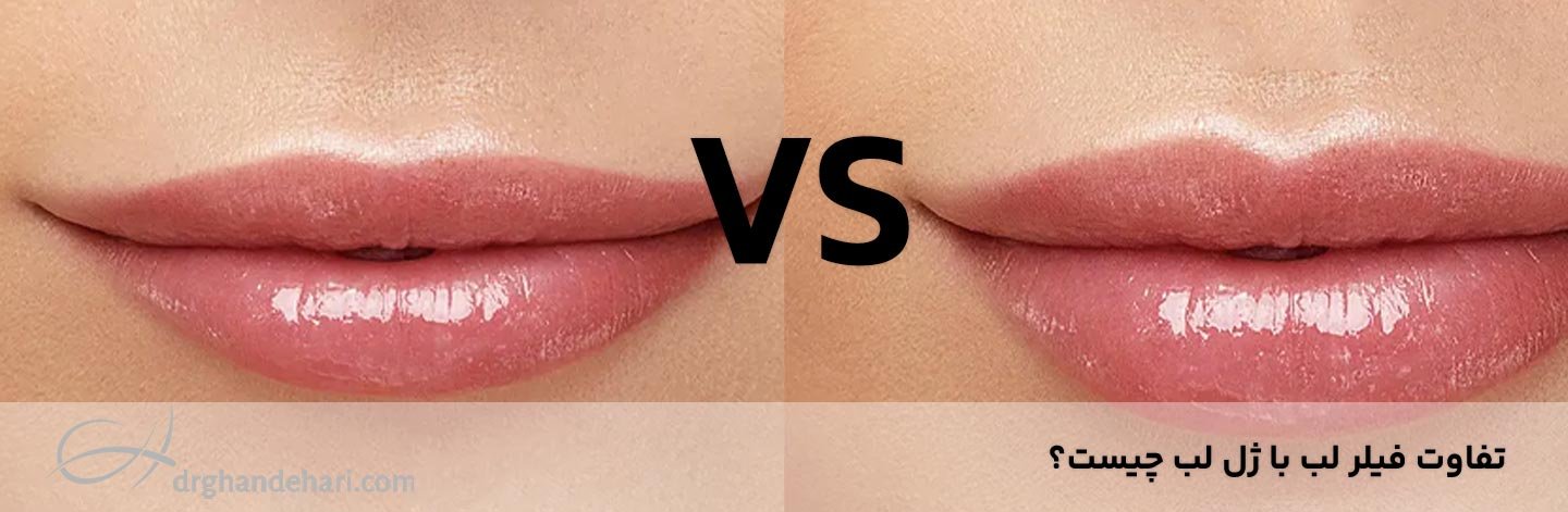 4 تفاوت فیلر لب با ژل لب که باید بدانید!