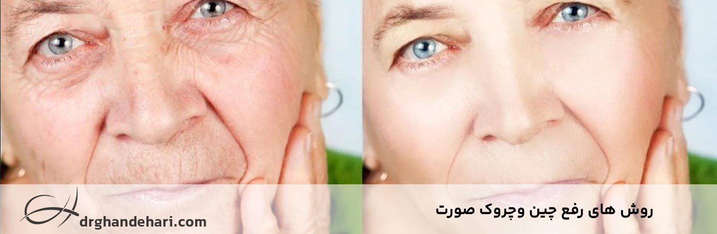 رفع چین و چروک صورت - پیشگیری و درمان چروک های عمیق پوستی