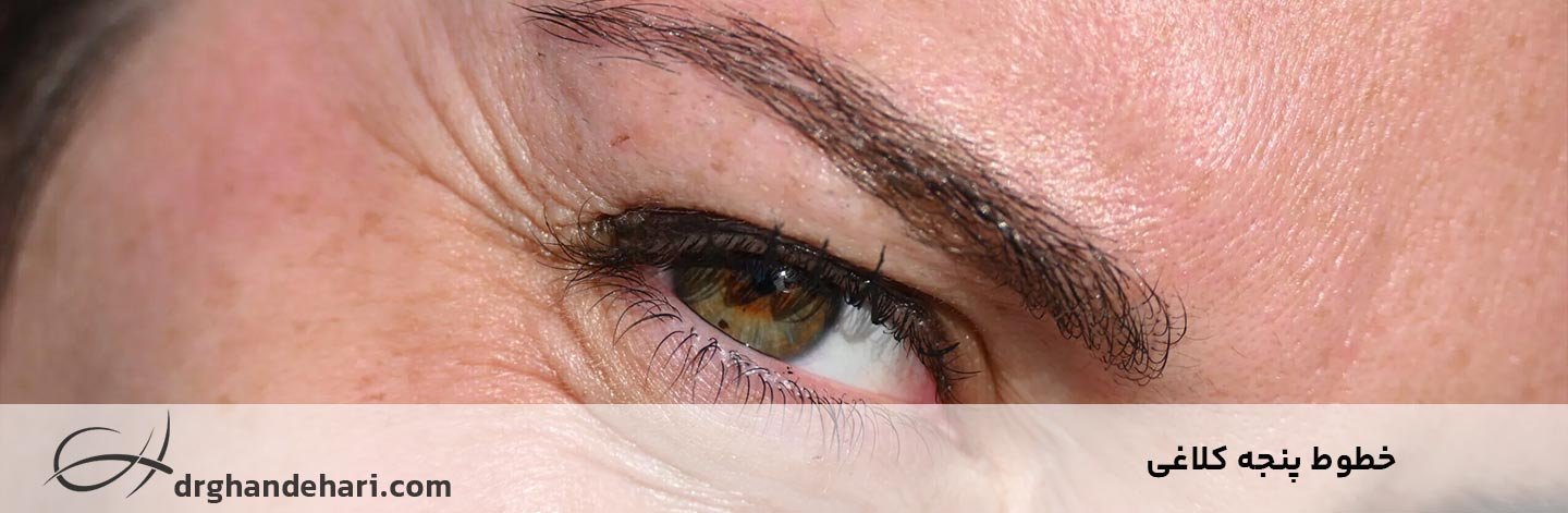 خطوط پنجه کلاغی دور چشم؛ علت و درمان چروک پنجه کلاغی