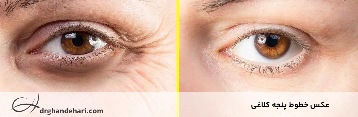 عکس چروک پنجه کلاغی عکس چروک پنجه کلاغی